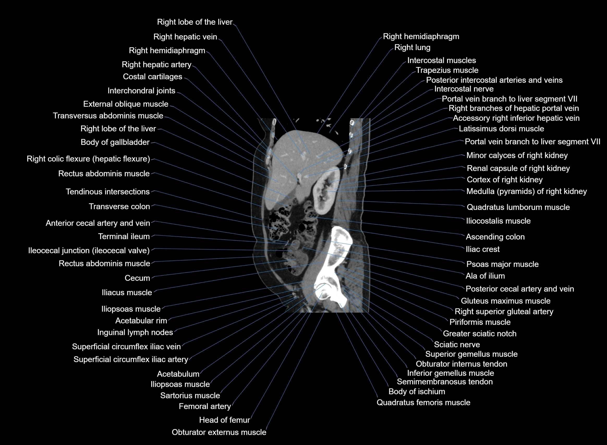 CT Abdomen sagittal cross sectional anatomy labelled radiology image -00081.webp